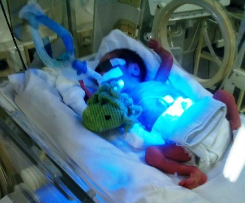 EL PRIMER AÑO DEL BEBE PREMATURO
